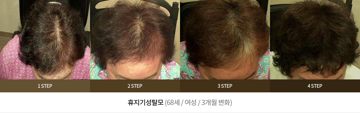 휴지기성탈모 (68세 / 여성 / 3개월 변화)